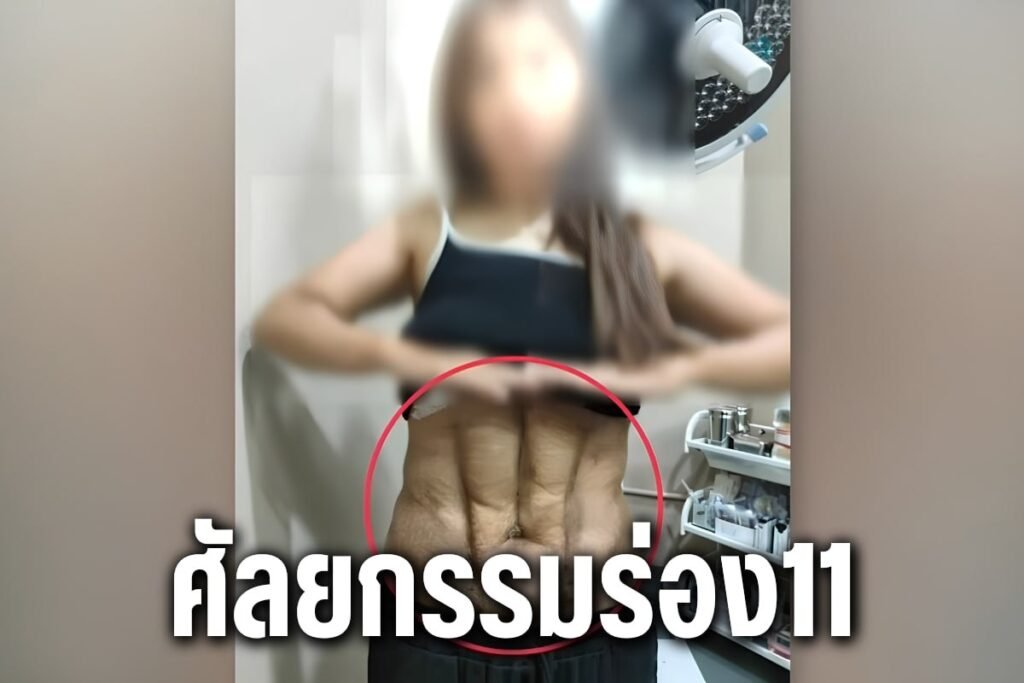 ศัลยกรรมร่อง11